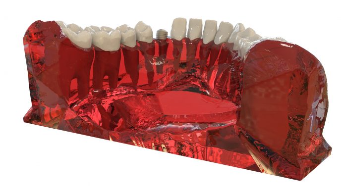 implant dentar din Bucuresti